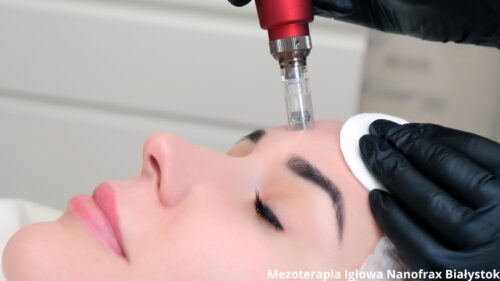 mezoterapia igłowa nanofrax w salonie medycyny estetycznej w białymstoku